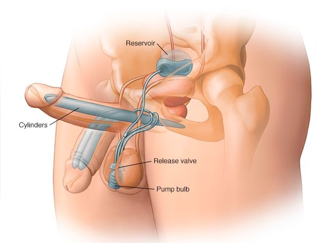 image14 Diagram of surgical implants used to treat Peyronie's Disease by the NHS